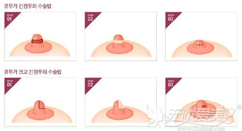 乳房缩小术的过程原理