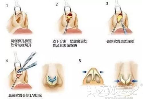 魏亨坤告诉你做完鼻头鼻翼缩小发现鼻子增生该怎么解决？