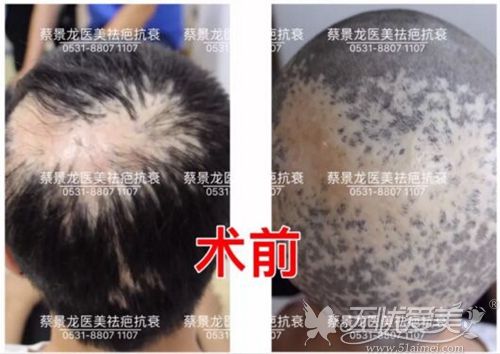 在济南蔡景龙治疗瘢痕秃发的顾客