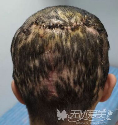 在济南蔡景龙治疗瘢痕秃发的顾客术后10天