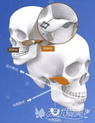 上海愉悦美联臣颧骨颧弓移动术手术过程