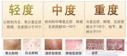 桂林星范治疗不同种类的痘痘