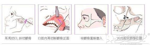 磨骨手术的原理