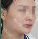 案例:没想到在上海就能体验到韩国曹栋弼做的长曲线下颌角