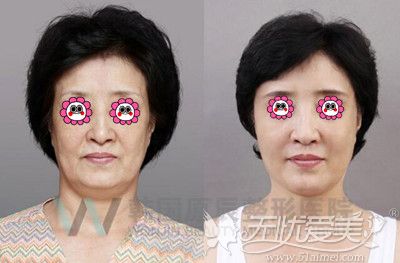 韩国原辰线雕面部提升效果对比