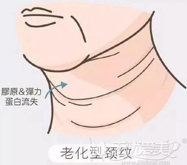 火鸡脖可以在梅州曙光整形做嗨体去颈纹 效果如何看照片