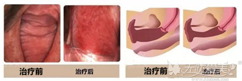 韩国好手艺私密整形后方膣圆盖术手术前后效果对比