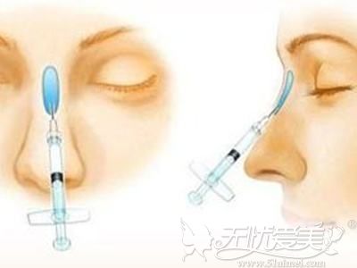 玻尿酸隆鼻原理