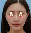 她在武汉艺星花2800竟然做到进口假体隆鼻GET迷人的“侧颜杀术前