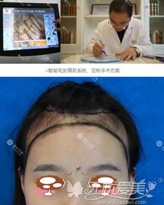重庆华美工作人员做发际线移植前设计
