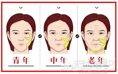 齐齐哈尔君悦回答：43岁做面部提升哪种方法维持时间久？