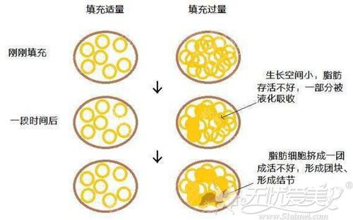 脂肪填充过多汗蒸能消掉吗?广州曙光建议吸脂或者激光溶脂