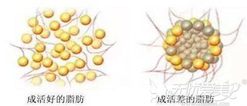 脂肪成活好坏对比