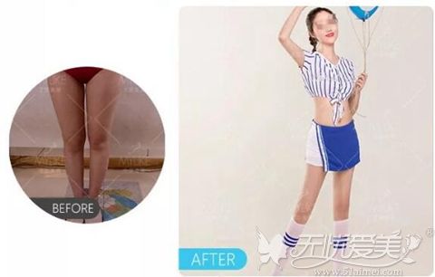 北京美莱大腿吸脂案例