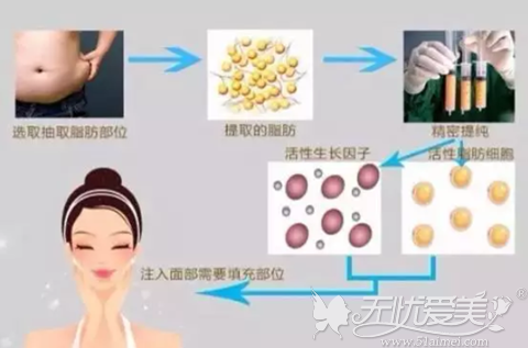 自体脂肪填充面部手术过程 自体脂肪填充面部手术过程