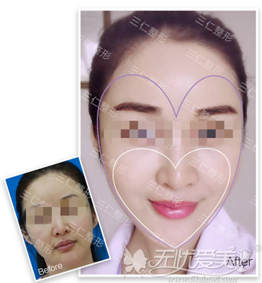 三亚三仁整形面部填充真人案例 三亚三仁整形面部填充真人案例