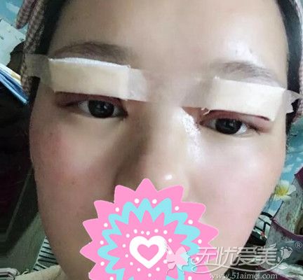台州双眼皮手术当天