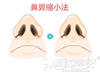 鼻整形鼻翼缩小手术方法