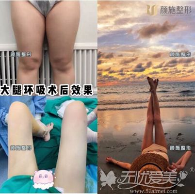 厦门颜施顾客做大腿吸脂前后