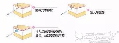 玻尿酸填充面部的原理