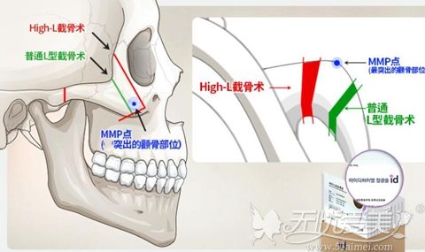 韩国ID整形High-L颧骨手术