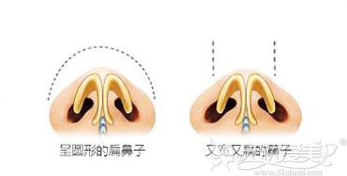 鼻头大鼻翼宽的鼻子