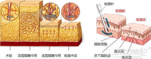 洛阳华美帮我回答了为什么明星不做抽脂是不是担心后遗症