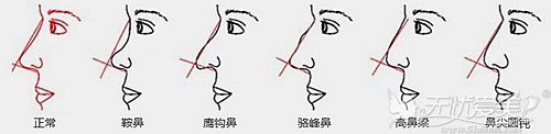 柔美弧综合隆鼻可以改善多种鼻型