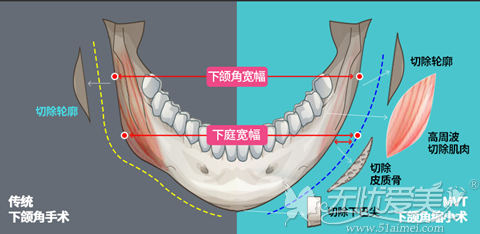 韩国ID整形下颌角手术与传统手术区别