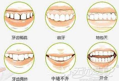 牙齿不美观的多种形态