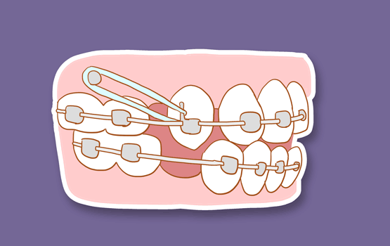 牙齿矫正的过程解析
