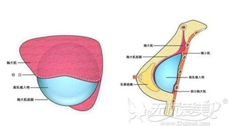 韩国原辰整形将假体放置的胸部位置