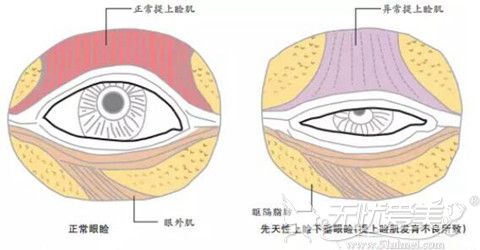 李承焕上睑提肌矫正