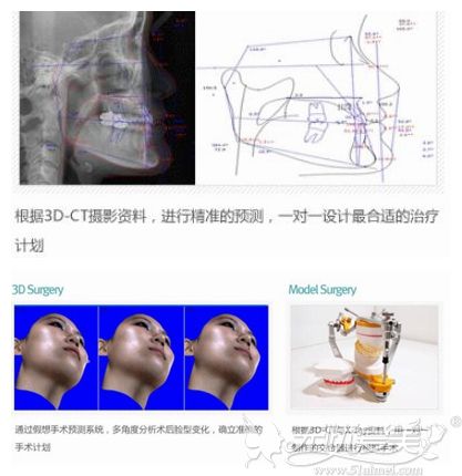 韩国原辰3D模拟双鄂手术效果