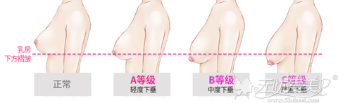 哺乳后胸部下垂 到韩国ID整形做下垂矫正术帮你重拾胸部Q弹
