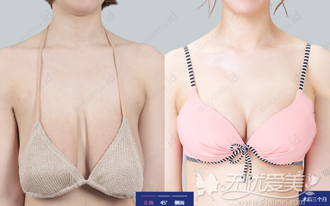 韩国ID整形胸部下垂真人案例