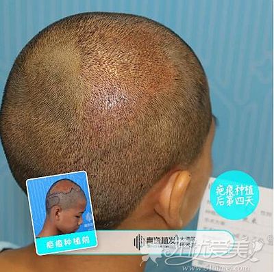 在广州青逸做疤痕植发四天后的效果