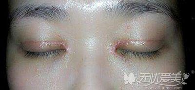如何避免全切双眼皮术后出现疤痕增生