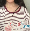 在广州中家医做内窥镜双平面隆胸15天的效果就令我吃惊