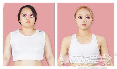 韩国365mc兰斯吸脂术前术后对比