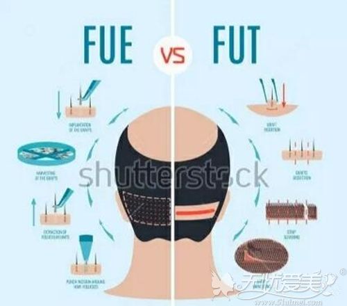 FUE和FUT植发技术的区别