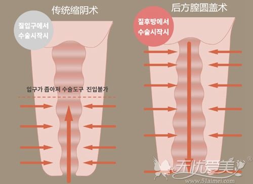 韩国好手艺后方膣圆盖术和传统缩阴术区别