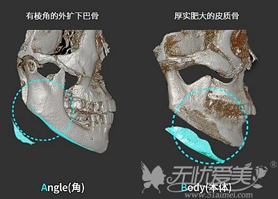 韩国ID的MVP下颌角缩小手术原理