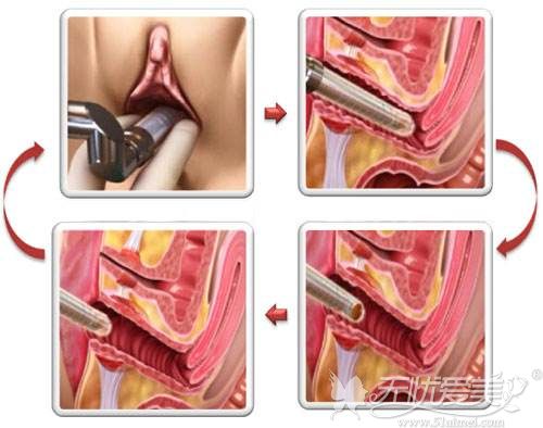 菲蜜丽治疗阴道松弛过程