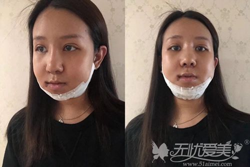 在韩国艾恩做下颌角+面部脂肪填充术后3天