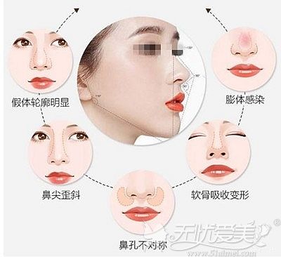 我做了5次鼻子还能做吗?上海美联臣擅长鼻修复的荣峥给意见