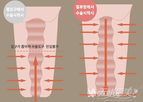 韩国好手艺阴道紧缩术和普手术的区别