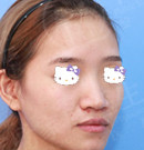 一个月前在广州中家医做完鼻综合后 我准备再去割个双眼皮