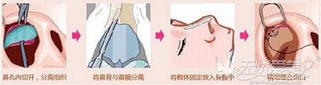 假体隆鼻的适应人群和手术方式