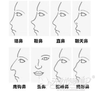 六安菲凡鼻综合可以改善鼻型